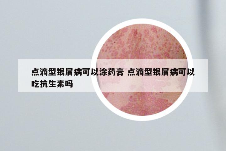点滴型银屑病可以涂药膏 点滴型银屑病可以吃抗生素吗