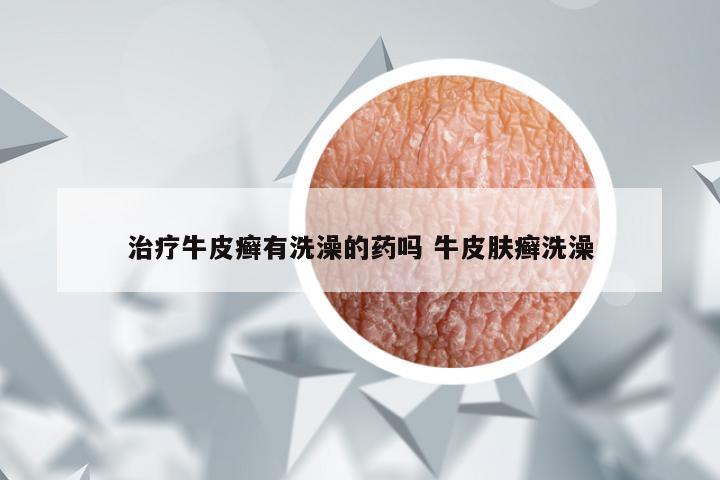 治疗牛皮癣有洗澡的药吗 牛皮肤癣洗澡