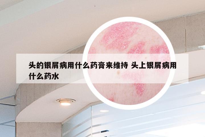头的银屑病用什么药膏来维持 头上银屑病用什么药水