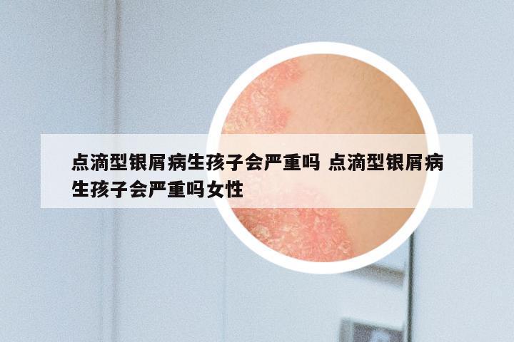 点滴型银屑病生孩子会严重吗 点滴型银屑病生孩子会严重吗女性
