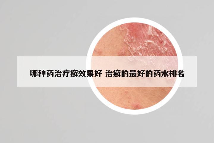 哪种药治疗癣效果好 治癣的最好的药水排名