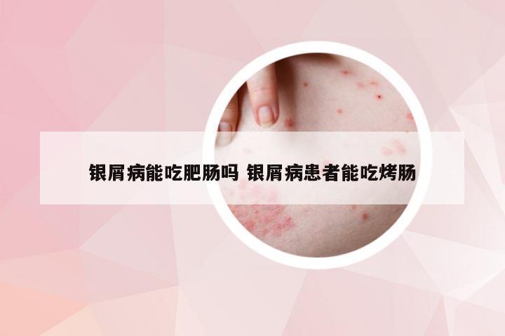 银屑病能吃肥肠吗 银屑病患者能吃烤肠