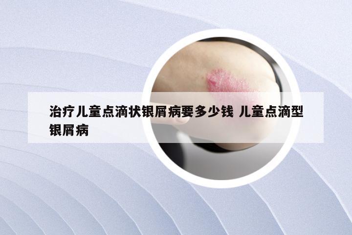 治疗儿童点滴状银屑病要多少钱 儿童点滴型银屑病