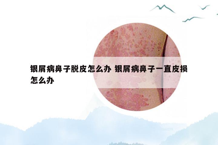 银屑病鼻子脱皮怎么办 银屑病鼻子一直皮损怎么办