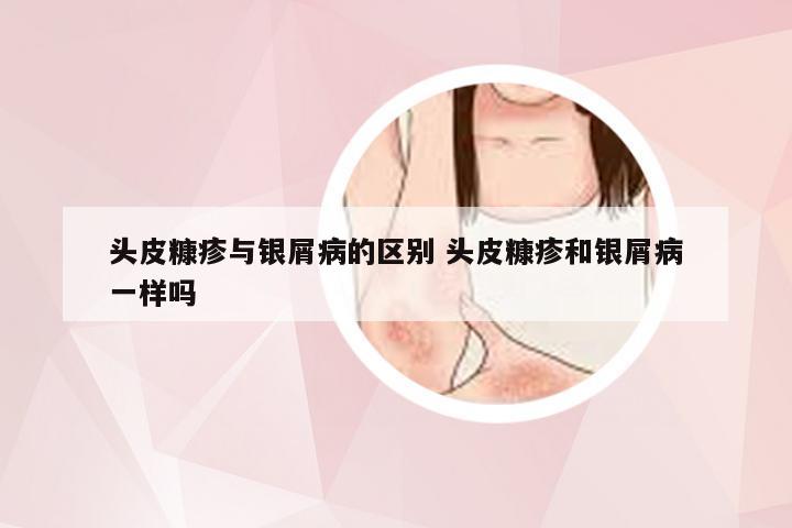 头皮糠疹与银屑病的区别 头皮糠疹和银屑病一样吗