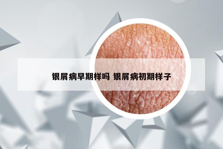 银屑病早期样吗 银屑病初期样子