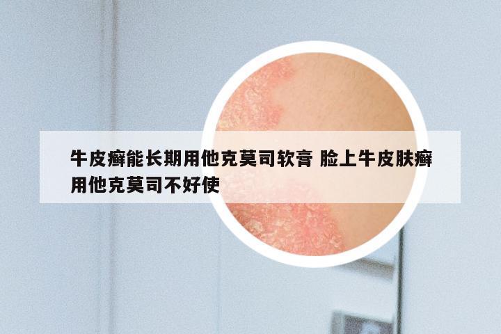 牛皮癣能长期用他克莫司软膏 脸上牛皮肤癣用他克莫司不好使