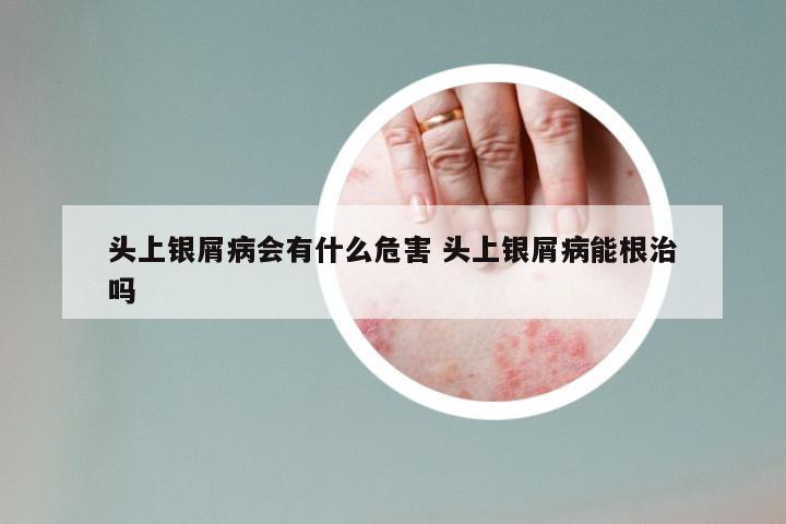 头上银屑病会有什么危害 头上银屑病能根治吗