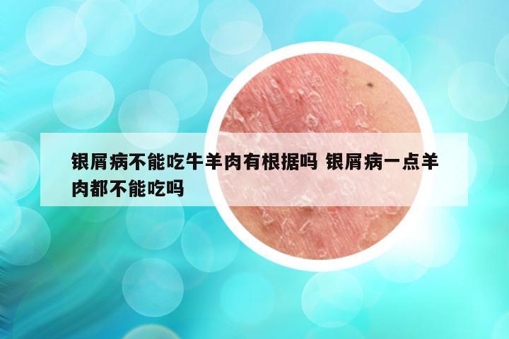 银屑病不能吃牛羊肉有根据吗 银屑病一点羊肉都不能吃吗