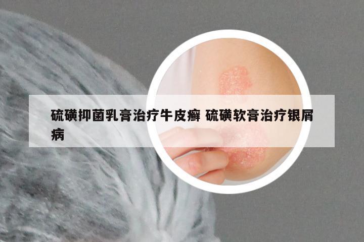 硫磺抑菌乳膏治疗牛皮癣 硫磺软膏治疗银屑病
