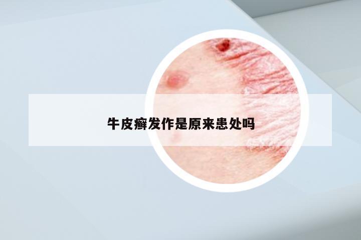 牛皮癣发作是原来患处吗