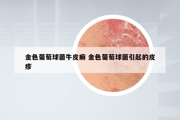 金色葡萄球菌牛皮癣 金色葡萄球菌引起的皮疹