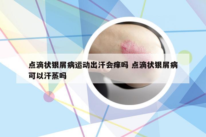 点滴状银屑病运动出汗会痒吗 点滴状银屑病可以汗蒸吗