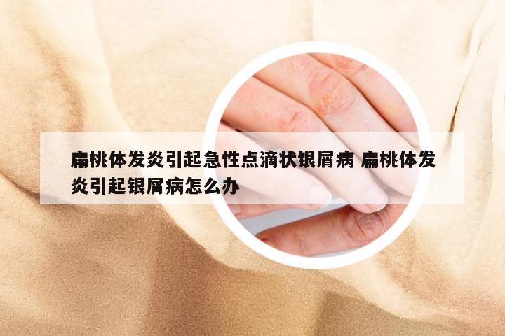 扁桃体发炎引起急性点滴状银屑病 扁桃体发炎引起银屑病怎么办