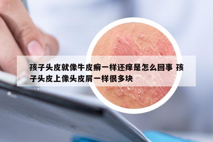 孩子头皮就像牛皮癣一样还痒是怎么回事 孩子头皮上像头皮屑一样很多块