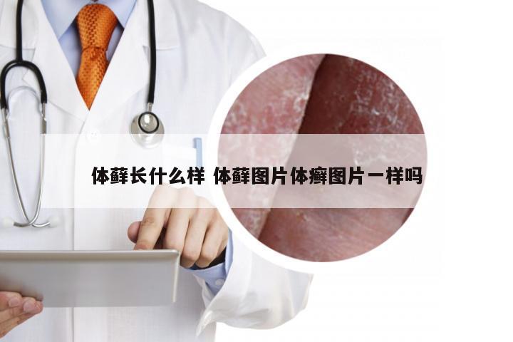 体藓长什么样 体藓图片体癣图片一样吗
