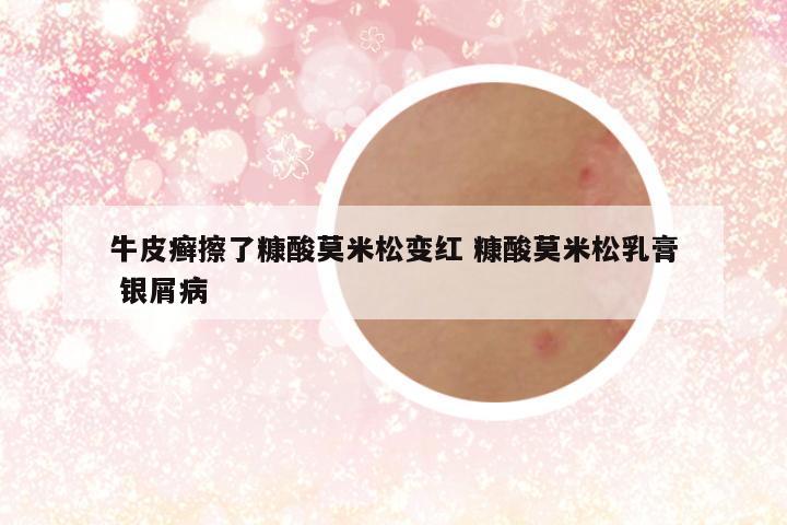 牛皮癣擦了糠酸莫米松变红 糠酸莫米松乳膏 银屑病