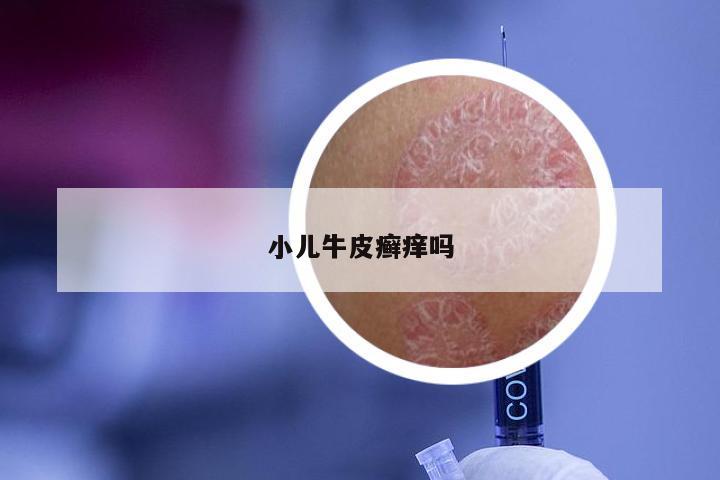小儿牛皮癣痒吗