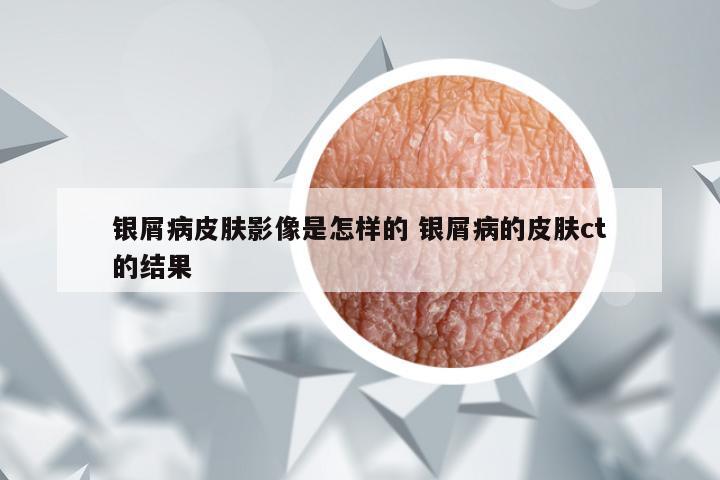 银屑病皮肤影像是怎样的 银屑病的皮肤ct的结果