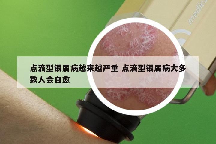 点滴型银屑病越来越严重 点滴型银屑病大多数人会自愈