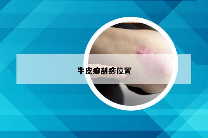 牛皮癣刮痧位置