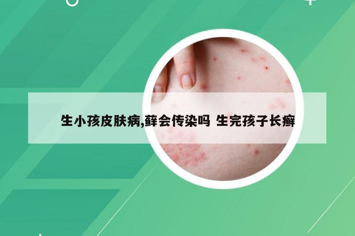 生小孩皮肤病,藓会传染吗 生完孩子长癣
