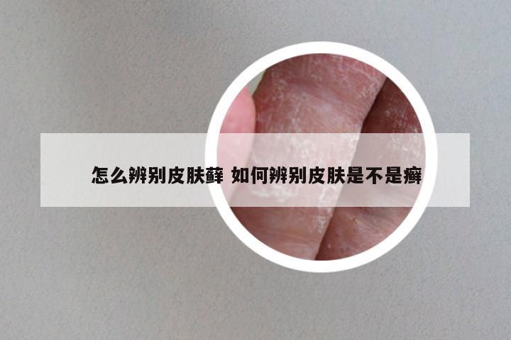 怎么辨别皮肤藓 如何辨别皮肤是不是癣