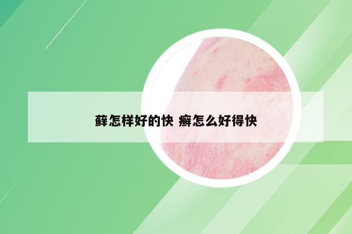藓怎样好的快 癣怎么好得快