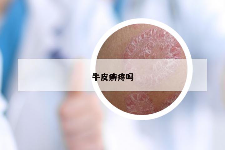 牛皮癣疼吗