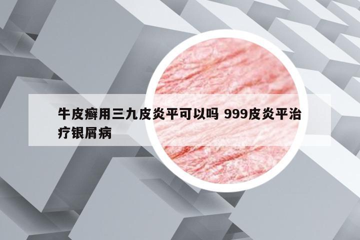 牛皮癣用三九皮炎平可以吗 999皮炎平治疗银屑病