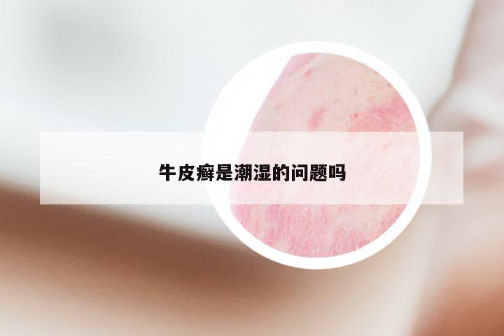 牛皮癣是潮湿的问题吗