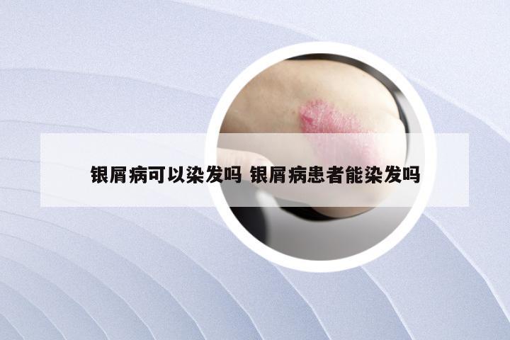 银屑病可以染发吗 银屑病患者能染发吗