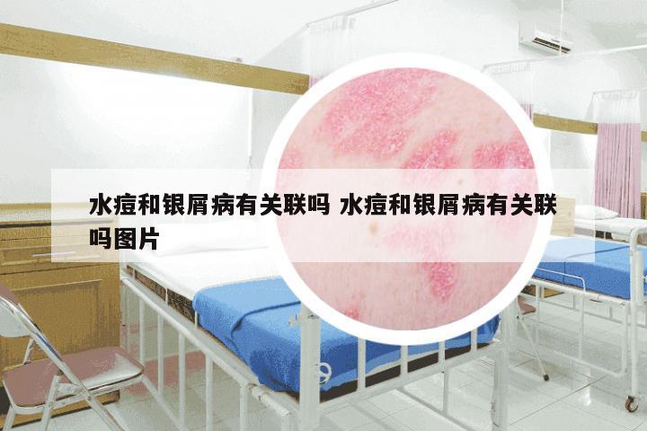 水痘和银屑病有关联吗 水痘和银屑病有关联吗图片