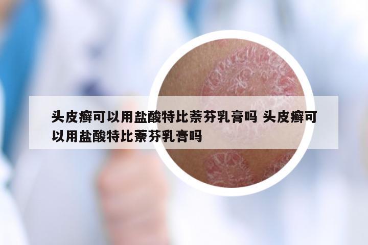 头皮癣可以用盐酸特比萘芬乳膏吗 头皮癣可以用盐酸特比萘芬乳膏吗