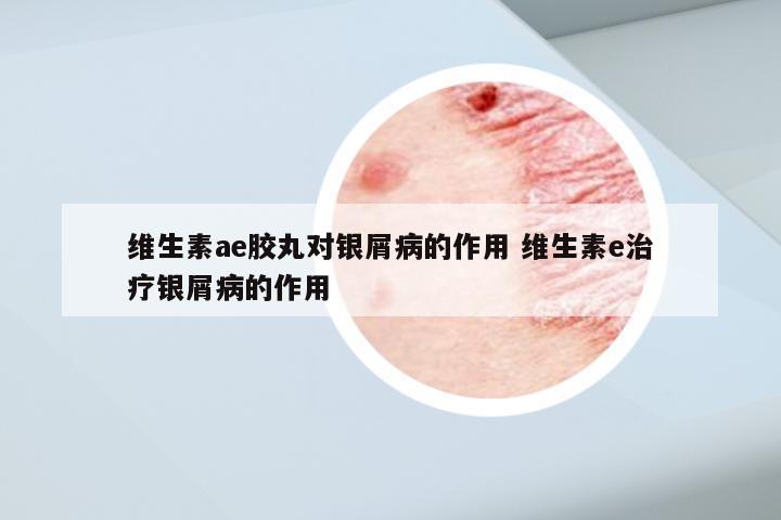 维生素ae胶丸对银屑病的作用 维生素e治疗银屑病的作用