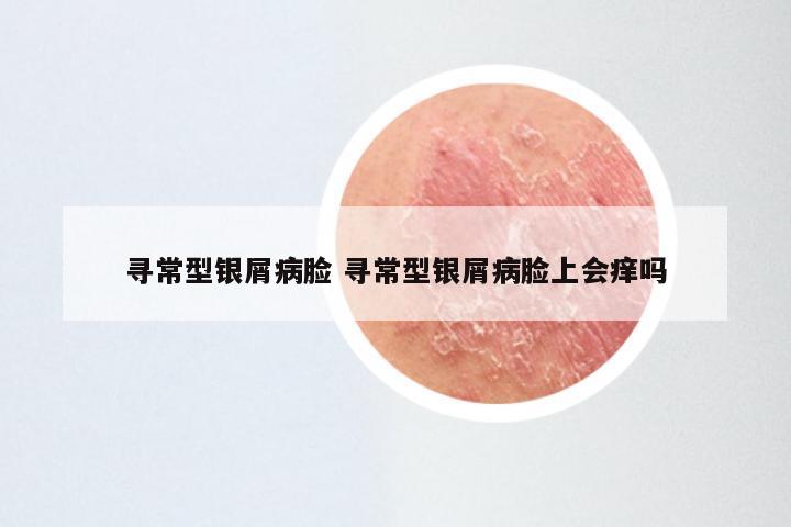 寻常型银屑病脸 寻常型银屑病脸上会痒吗