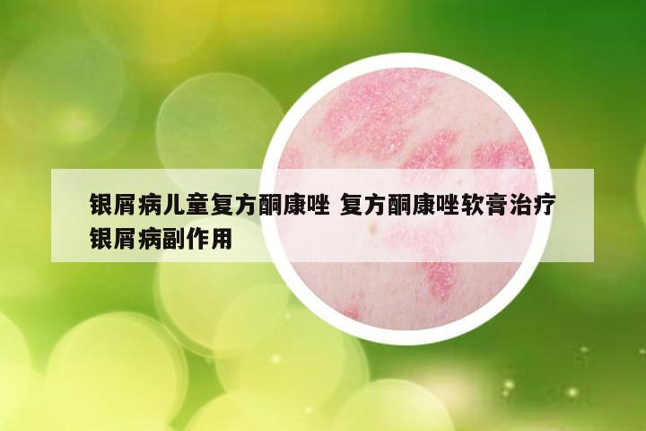 银屑病儿童复方酮康唑 复方酮康唑软膏治疗银屑病副作用