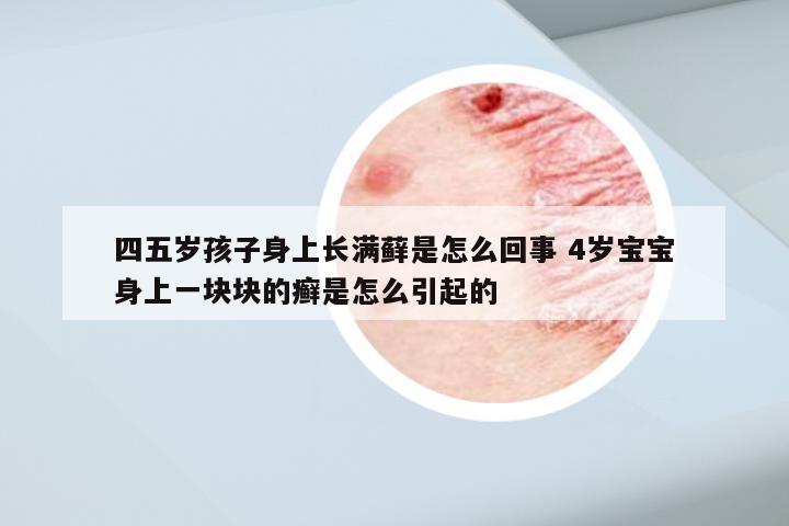 四五岁孩子身上长满藓是怎么回事 4岁宝宝身上一块块的癣是怎么引起的