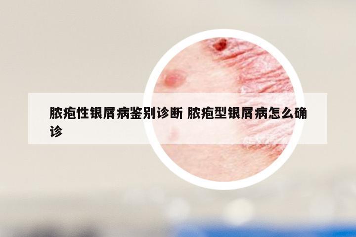 脓疱性银屑病鉴别诊断 脓疱型银屑病怎么确诊