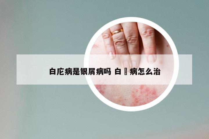 白庀病是银屑病吗 白疕病怎么治