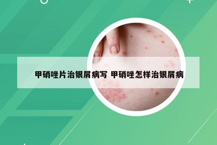 甲硝唑片治银屑病写 甲硝唑怎样治银屑病