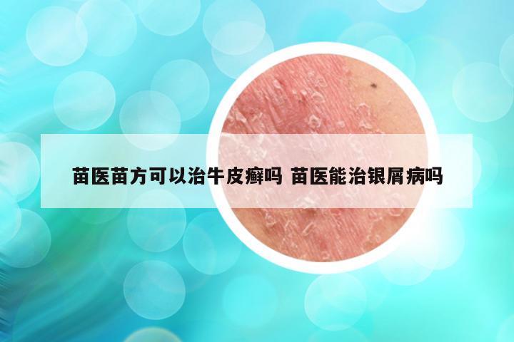 苗医苗方可以治牛皮癣吗 苗医能治银屑病吗