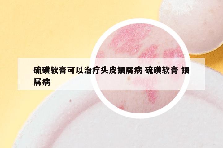 硫磺软膏可以治疗头皮银屑病 硫磺软膏 银屑病