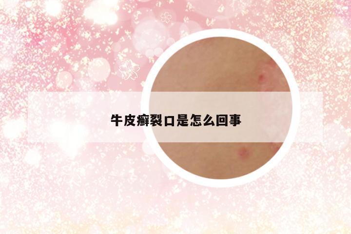 牛皮癣裂口是怎么回事