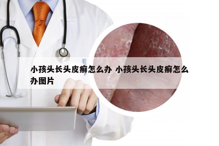 小孩头长头皮癣怎么办 小孩头长头皮癣怎么办图片