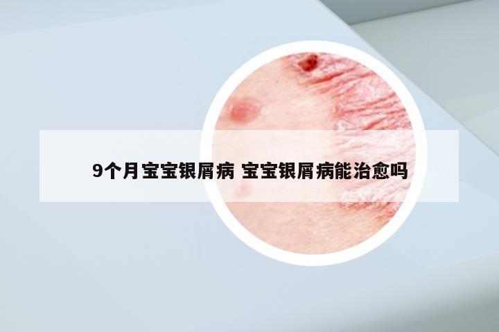 9个月宝宝银屑病 宝宝银屑病能治愈吗