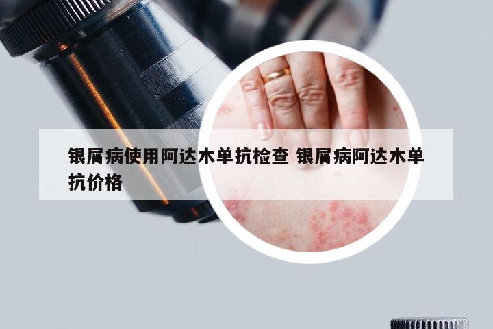 银屑病使用阿达木单抗检查 银屑病阿达木单抗价格
