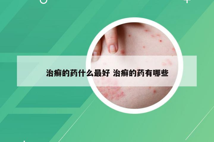 治癣的药什么最好 治癣的药有哪些