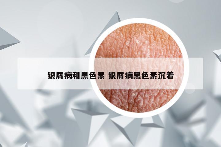 银屑病和黑色素 银屑病黑色素沉着