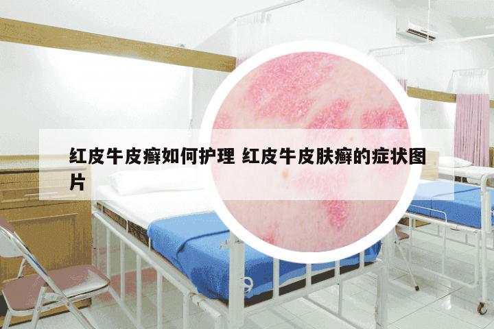 红皮牛皮癣如何护理 红皮牛皮肤癣的症状图片